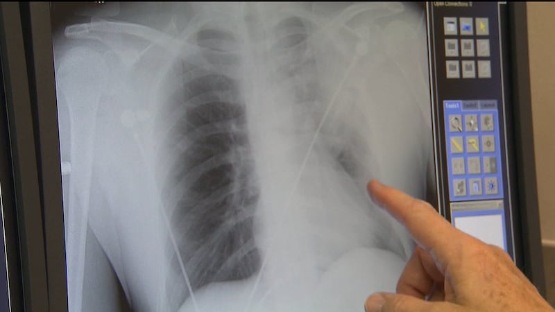 FILE - A study shows higher rates of lung cancer in women than men; the reason is a mystery...